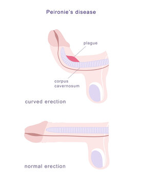 Medical chart of Peyronie's disease. Side view of human penis in normal erection and curved, demonstrating fibrous plague on its erectile tissue.