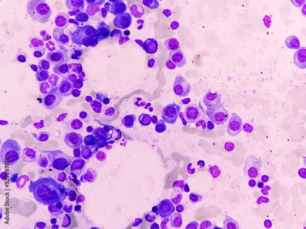 Wall mural microscopic view of bone marrow slide feature are suggestive multiple myeloma, also known as myeloma