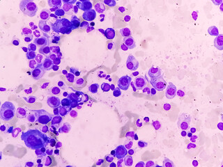 Microscopic view of bone marrow slide feature are suggestive Multiple myeloma, also known as...