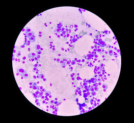Microscopic view of bone marrow slide feature are suggestive Multiple myeloma, also known as myeloma, is a type of bone marrow cancer.