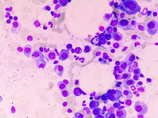 Microscopic view of bone marrow slide feature are suggestive Multiple myeloma, also known as myeloma, is a type of bone marrow cancer.