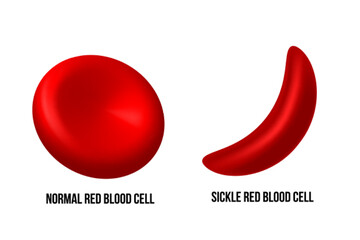 Sickle cell disease. The difference of Normal red blood cell and sickle cell.