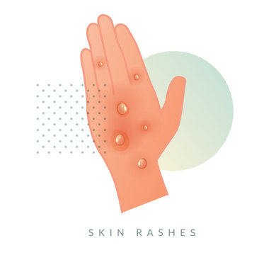Monkeypox - Skin Rashes and Spots as Symptoms - Icon