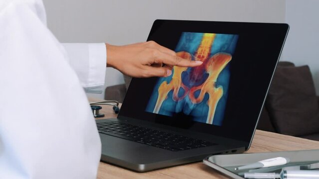 Woman Doctor showing x-ray with pain in the hips and spine on a laptop. Left to right shot