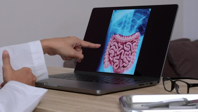 Close up of hand of a woman doctor showing a x-ray of stomach and intestine on a laptop.