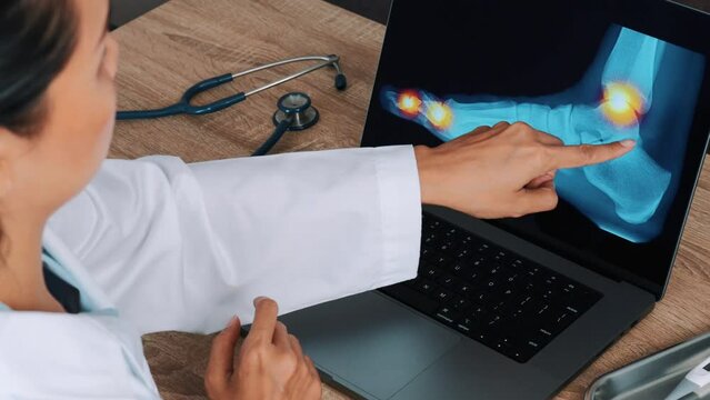 Woman doctor showing a x-ray of foot with pain in the toes and ankle on a laptop