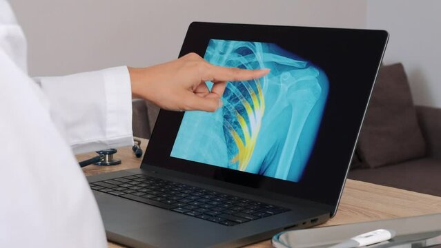 Woman Doctor showing x-ray with pain on the ribs on a laptop. Left to right shot