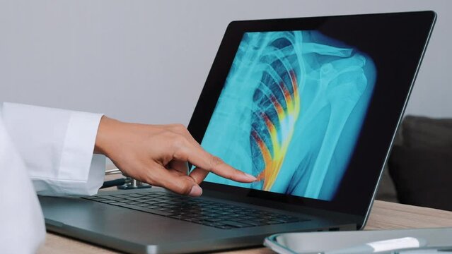 Woman Doctor showing x-ray with pain on the ribs on a laptop. Slow motion