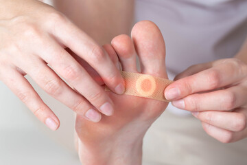 Woman sticks a medical plaster to the plantar wart of the leg to remove dead skin and calluses, close-up - obrazy, fototapety, plakaty