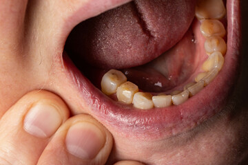 Crowned teeth. Preparation of teeth in dentistry for the installation of prostheses. Macro