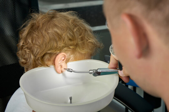 To Wash Ears With Water Irrigator, An Experienced Doctor Substitutes A Special Funnel To Child's Ear To Collect Water. Close-up Of Procedure For Cleaning Children's Ears From Ear Plugs In ENT Room