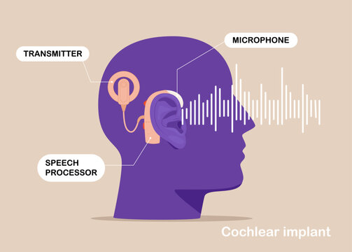 Cochlear implant device electrically stimulates nerve medical aid ear sound wave adults hard middle exam. Vector illustration.
