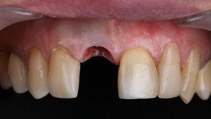 installed dental implant in the area of the central tooth without a crown - obrazy, fototapety, plakaty