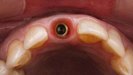 gingival cavity of the installed implant and abutment, view through the mirror