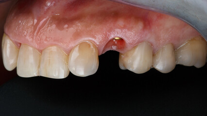 Obraz premium composition of the upper jaw before placing one crown on the implant