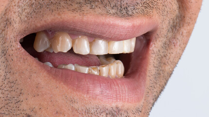 dental job photography, crowns veneers implants
