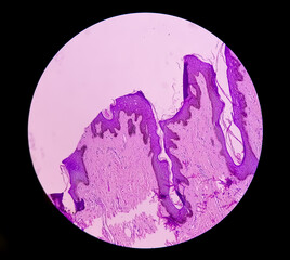 Histological biopsy of Scrotal wall under microscopy showing Calcinosis cutis. Scrotal calcinosis. Calcinosis cutis of scrotum