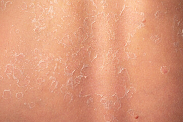 Fototapeta premium Sunburn, close-up of human skin. Flaky skin from allergies, peeling or eczema. Dry skin in need of treatment and hydration.