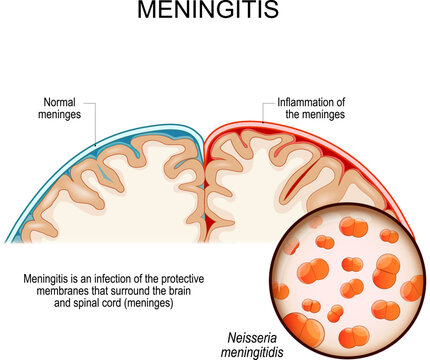 Meningitis. brain with Normal meninges and Inflammation of the meninges. 