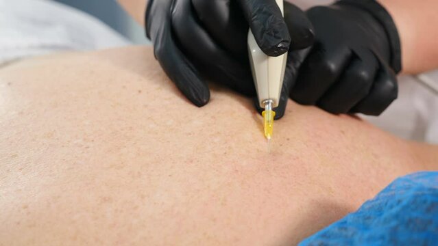 Aesthetic beauty clinic. Mesotherapy, ozone therapy. Carbon dioxide carboxy therapy. CO2 injections. Skin rejuvenation. Cosmetologist doctor using needle on device for gas injections of carboxytherapy