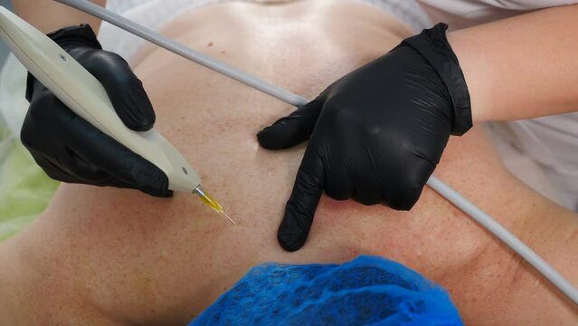 Carboxytherapy injections. Gas invasive therapy. Top view. Cosmetologist using carbon dioxide CO2 injection machine on back. Senior woman getting body care fat treatment. Skin rejuvenation. 4 k video