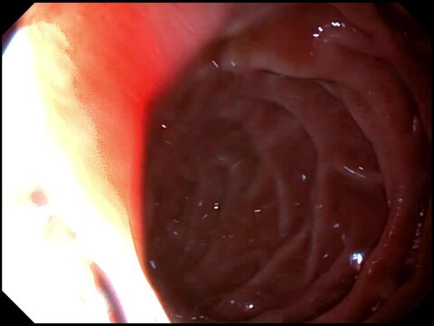 Gastroscopy examination of the gullet and stomach