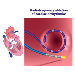 Radiofrequency catheter ablation of the heart. Illustration with a surgical procedure. Medical poster. Vector illustration