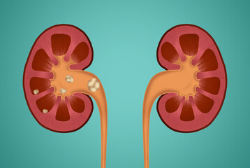 Illustration of human kidneys, one with stones on blue background