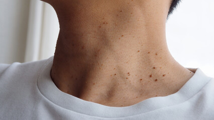 Many skin tags or Acrochordon on the neck They are small soft and common benign on the human skin...