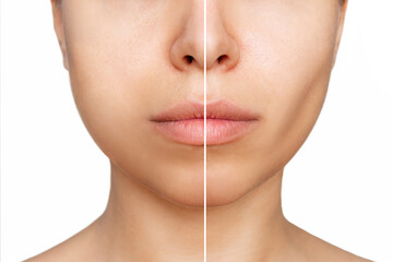 Cropped shot of young woman's face before and after plastic surgery buccal fat pad removal on a...