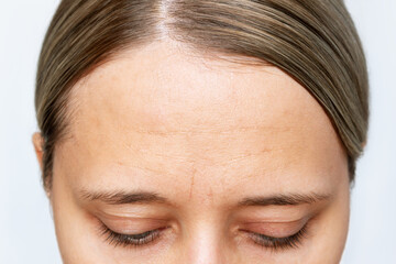 Cropped shot of young caucasian woman with wrinkles on the forehead on a white background. Wrinkling the forehead. Skin care. Age-related changes. Beauty concept