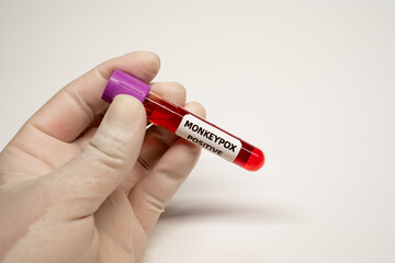 Close-up of Blood sample tube positive with Monkeypox virus,monkeypox positive