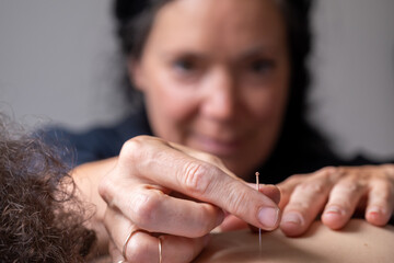 Profesional woman giving acupuncture treatment. High quality photo