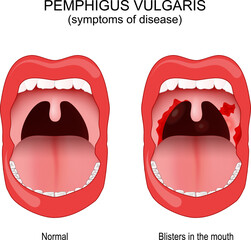 Pemphigus vulgaris. Early symptoms inside the mouth - obrazy, fototapety, plakaty