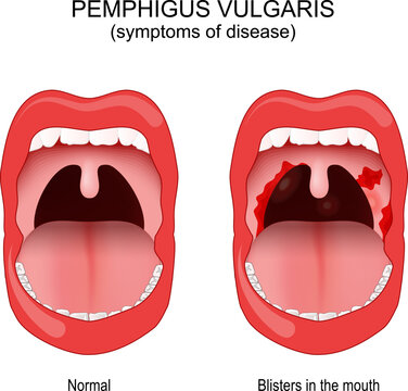 Pemphigus vulgaris. Early symptoms inside the mouth