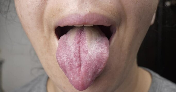 oral disease white coating on the tongue, woman tongue cancer. High quality 4k footage
