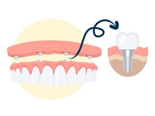 Dental implant structure medical vector illustration.