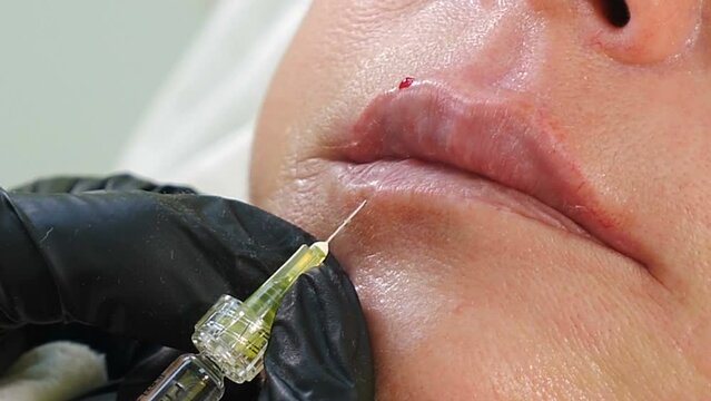 Beauty injection for lips. Close-up of hands of cosmetologist making injection in female lips. Lip augmentation and correction form. Woman undergoes lip plumping procedure. 4 k video