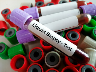 Blood samples for Liquid biopsy blood test to detect cancer cells or DNA fragments that circulate...