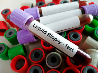 Blood samples for Liquid biopsy blood test to detect cancer cells or DNA fragments that circulate in the bloodstream, Lung cancer, laboratory background.