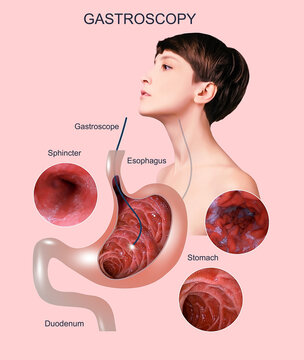 Digestive endoscopy or gastroscopy. Performing a gastroscopy procedure. Diagnostics of gastric diseases. Stomach health. Medical concept