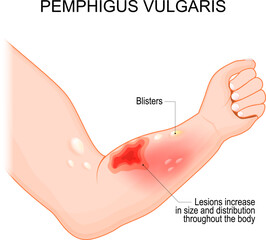 Pemphigus vulgaris. Arm with Blisters - obrazy, fototapety, plakaty