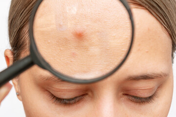 Cropped shot of a young woman demonstrating a red inflamed pimple on forehead enlarged in...