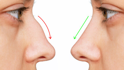 A profile of woman's face with nose before and after rhinoplasty isolated on white background. Comparison after cosmetic plastic surgery on the hump of the female nose. Correction of the nasal septum - obrazy, fototapety, plakaty
