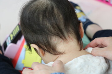 ウンナ母斑、赤ちゃん、皮膚病、赤、あざ