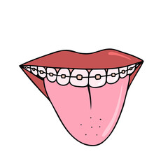 Mouth with tongue, braces. Vector Illustration for printing, backgrounds, covers and packaging. Image can be used for greeting cards, posters, stickers and textile. Isolated on white background.