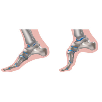 Charcot-Marie-Tooth Disease. Hereditary Disease. Foot Of A Patient With Characteristic Symptoms. Hereditary Motor-sensory Neuropathy. Damage To Motor And Sensory Peripheral Nerve Fibers.