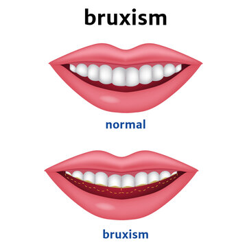 Bruxism. Diagram with worn teeth. Vector illustration