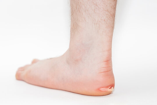 A man's leg with a burst callus. Close-up. White background. The concept of foot care and podology