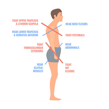 Upper and lower crossed syndrome medical diagram. Crooked man with muscle strength imbalance. Weak and overactive muscles therapy. Incorrect spine curvature caused by bad posture. Vector illustration.